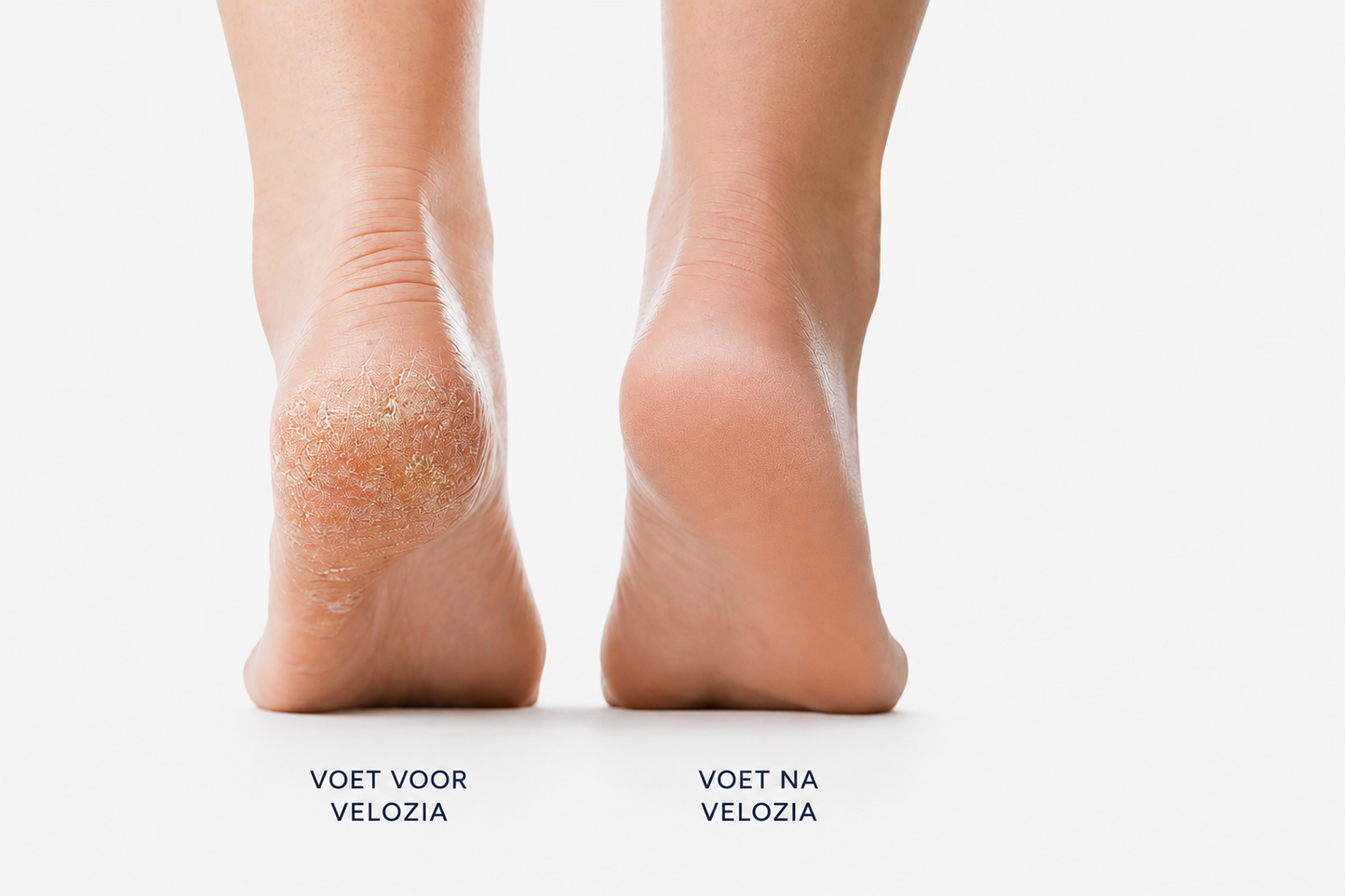 Velozia SmoothStep Pro – Elektrische Eeltverwijderaar voor Gladde en Zachte Voeten