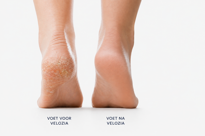 Velozia SmoothStep Pro – Elektrische Eeltverwijderaar voor Gladde en Zachte Voeten